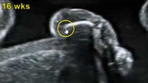<ol><li><p>What is abnormal about this image of the femur?</p></li><li><p>This image can be an US finding of what pathology?</p></li></ol><p></p>