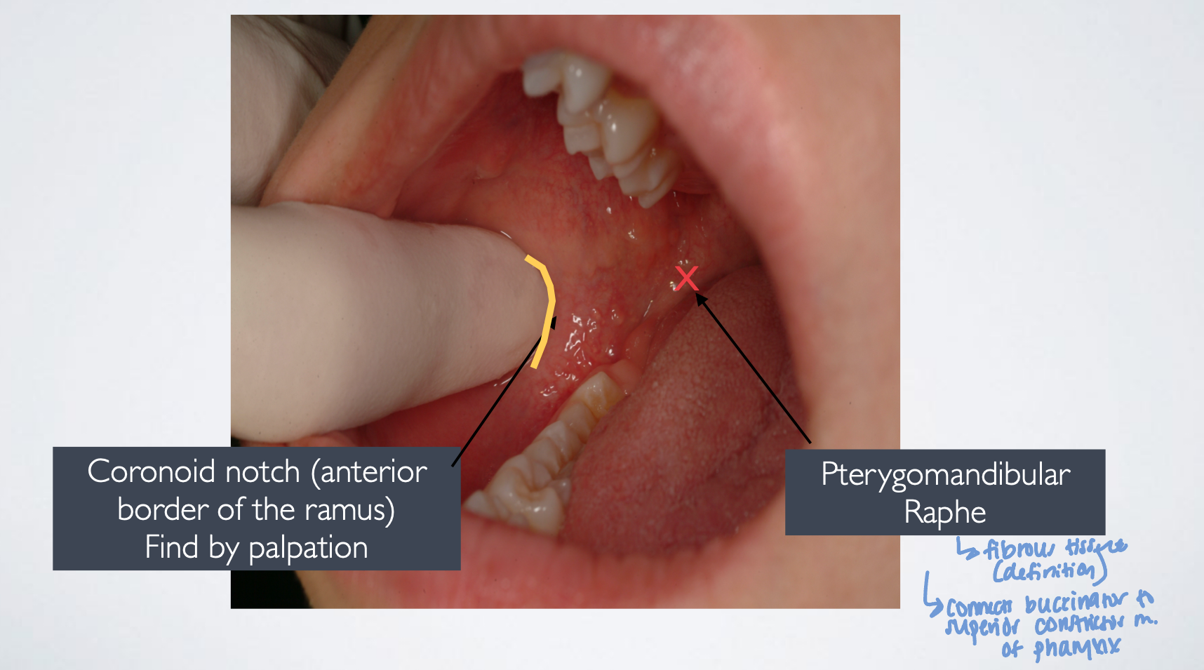 <p>coronoid notch and pterygomandibular raphe</p>