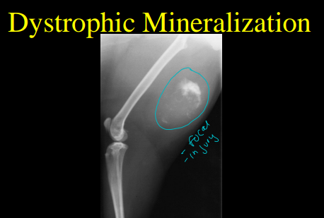 <ul><li><p><strong><u>Extra</u>capsular tissue swelling</strong></p><ul><li><p>Blood, pus, edema <strong><u>outside joint</u></strong></p></li><li><p><strong>Not centered</strong> around a joint</p></li></ul></li><li><p><strong><u>Intra</u>capsular tissue effusion</strong></p><ul><li><p>Blood, pus, edema <strong><u>within a joint</u></strong></p></li><li><p><strong>Centered </strong>around a joint space</p></li></ul></li><li><p><strong>Soft Tissue Emphysema</strong></p><ul><li><p><strong>Gas</strong> inside body</p><ul><li><p><strong>Outside:</strong> petrating injury or sx</p></li><li><p><strong>Bacti sorce: </strong>emphysematous bacteria like Clostridia</p></li><li><p><strong>From body:</strong> pneumoarthrogram (cracks)</p></li></ul></li></ul></li><li><p><strong>Soft Tissue Mineralization</strong></p><ul><li><p><strong>Dystrophic</strong></p><ul><li><p><strong>Focal</strong></p></li><li><p>Dead, dying tissue</p></li><li><p>Metaplasia to mineral</p></li><li><p>Normal Ca:P</p></li></ul></li><li><p><strong>Metastatic</strong></p><ul><li><p><strong>Diffuse</strong></p></li><li><p><strong>Abnormal Ca:P</strong></p></li></ul></li></ul></li></ul><p></p>