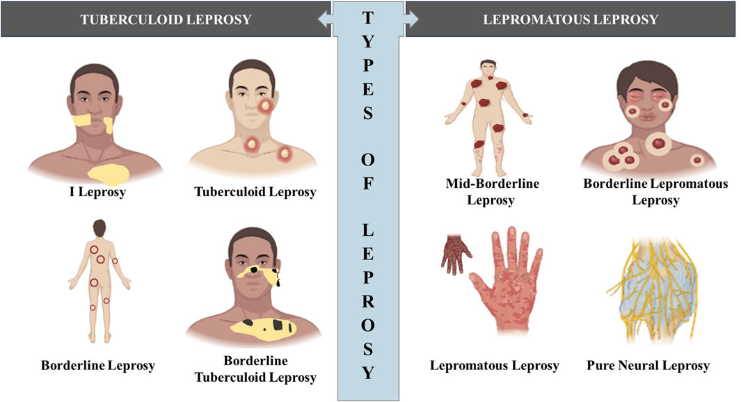 <ul><li><p>Tuberculoid leprosy (minor)</p><ul><li><p>Patients with strong cell-mediated immune responses</p></li><li><p>Non-progressive form of the disease</p></li><li><p>Skin that have loss sensation as a result of nerve damage</p></li></ul></li><li><p>Lepromatous leprosy (major)</p><ul><li><p>Patients with weak cell-mediated immune responses</p></li><li><p>Progressive form of disease</p></li><li><p>Bacterium multiplies in the skin, mucous membranes, and nerve cells, gradually destroying tissues and leading to the progressive loss of facial features, digits (fingers and toes), and other body structures</p></li></ul></li></ul><p></p>