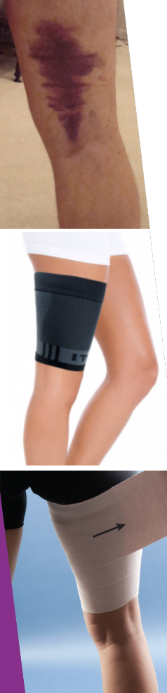 <p>Hamstring Strains</p>