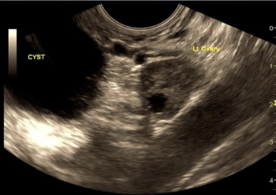 <p>a paraovarian cyst is aka</p><p>a) morgagni or gartner duct cyst</p><p>b) gartner duct or mesonephric cyst</p><p>c) mesonephric cyst or nabothian cyst</p><p>d) morgagni or mesonephric cyst </p>