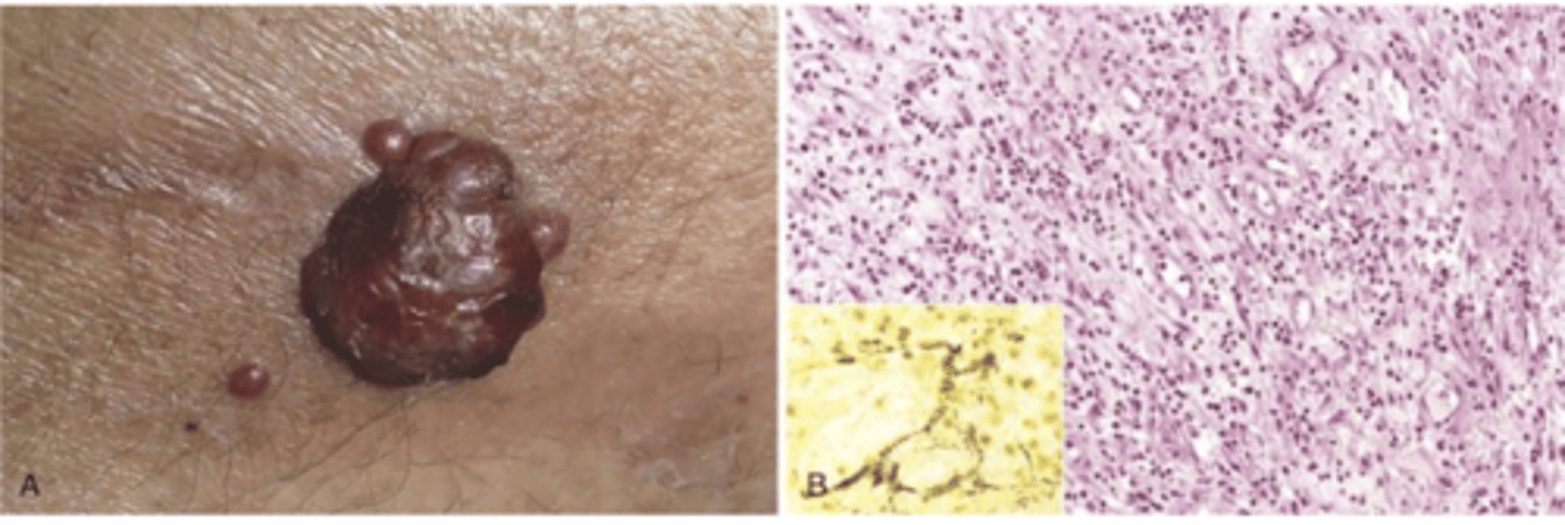 <p>vascular proliferation in immunocompromised hosts caused by bartonella infection</p><p>driven by VEGF production</p>