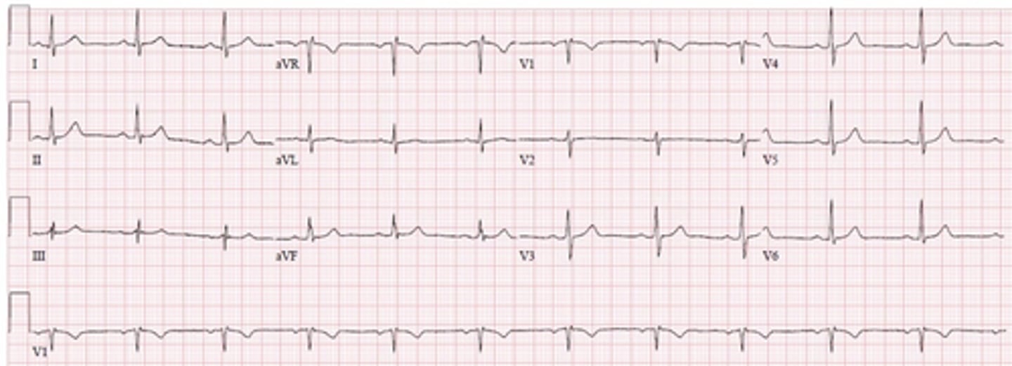 <p>A 14-year-old girl presents to the clinic due to increasing fatigue for 3 weeks. She is concerned because she experiences shortness of breath while playing soccer. She has no significant medical history, but she states that she has been following a strict vegan diet for 1 year. Vital signs are a T of 98.6°F, BP of 116/82 mm Hg, HR of 62 bpm, RR of 13 breaths/min, and SpO2 of 99% on room air. Physical exam reveals pallor and pale conjunctiva. An electrocardiogram was completed and is shown above. Which of the following lab values are consistent with the presumed diagnosis?</p><p>AD-dimer of 600 ng/mL</p><p>BFerritin of 75 µg/L</p><p>CRed blood cell distribution width of 7%</p><p>DTotal iron-binding capacity of 470 µg/dL</p>
