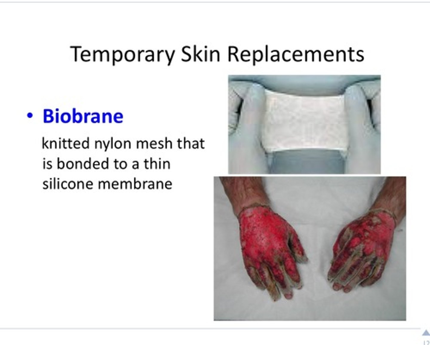 <p>1. synthetic nylon mesh covered with silicone rubber membrane</p><p>2. semi-permeable to water</p><p>3. protective barrier to micro-organisms</p><p>4. temporary cover for partial thickness burns</p><p>5. staging procedure for full thickness burns</p><p>6. good for children - less dressing change, less pain</p>