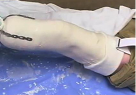 <ul><li><p><strong>Advantages:</strong> Immediate ambulation with limited weight bearing (will be connected to prosthetic foot!)</p><ul><li><p><span>↓ psychological traumatic period when limb is absent</span></p></li><li><p><span style="color: red;"><span>Less pain, mobilize faster,</span></span></p></li></ul></li><li><p><strong>Disadvantages: </strong>Possibly <span style="color: red;"><span>injurious effects,</span></span> particularly in weight bearing and its effects on wound healing</p><ul><li><p><span>Limits access to the surgical site, potential tissue damage and wound breakdown</span></p></li></ul></li></ul><p></p>