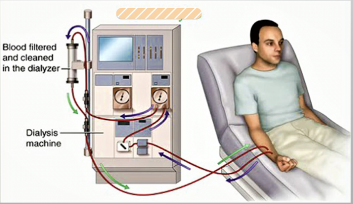 <p><strong><u>Cleans the blood of waste products and controls fluids by passing the blood through an artificial kidney, called a dialyzer</u></strong><br>→Patients must have a vascular access <em>(AV fistula, AV graft, tunnel direct catheter)</em><br><em>→can be done in a dialysis center or at home (3x week schedule)</em></p>