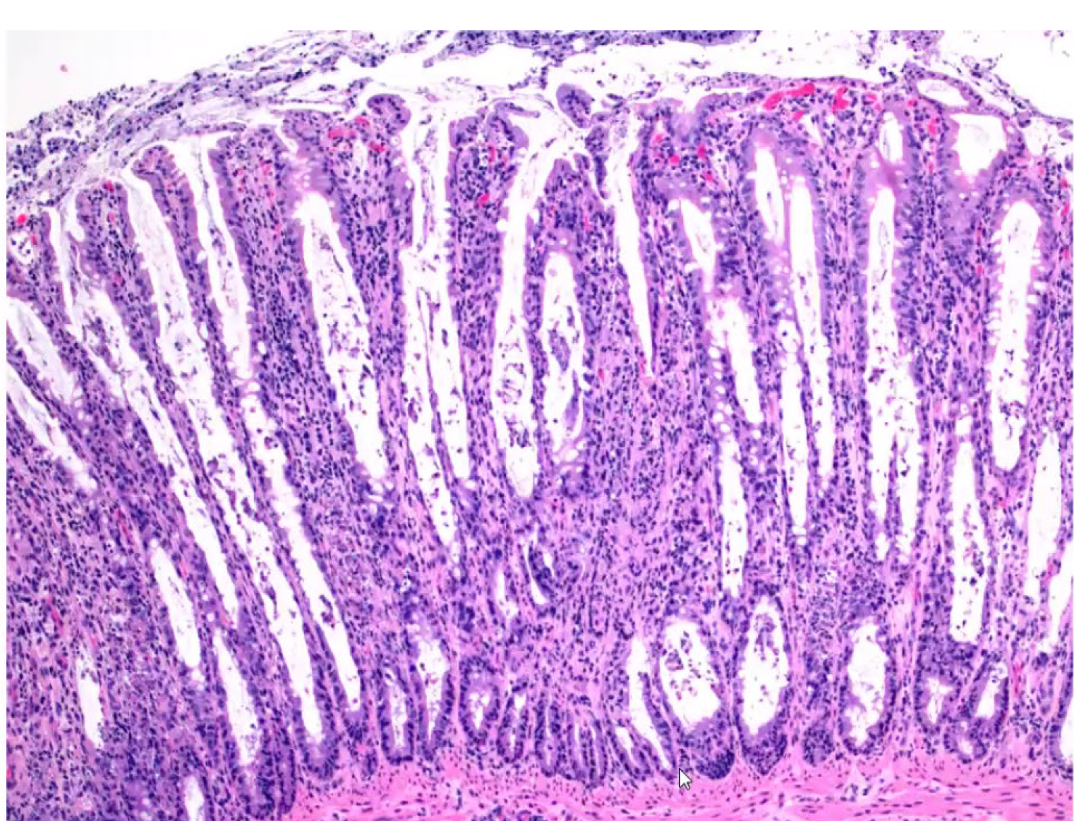 <p>Calf. What is the etiology?</p><p>A-Bovine coronavirus</p><p>B-Bovine viral diarrhea virus</p><p>C-Ovine herpesvirus type 2</p><p>D-Bovine rotavirus</p>