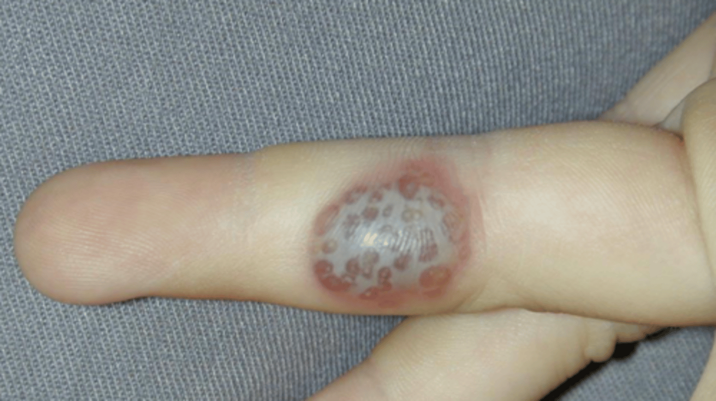 <p>herpetic whitlow</p>