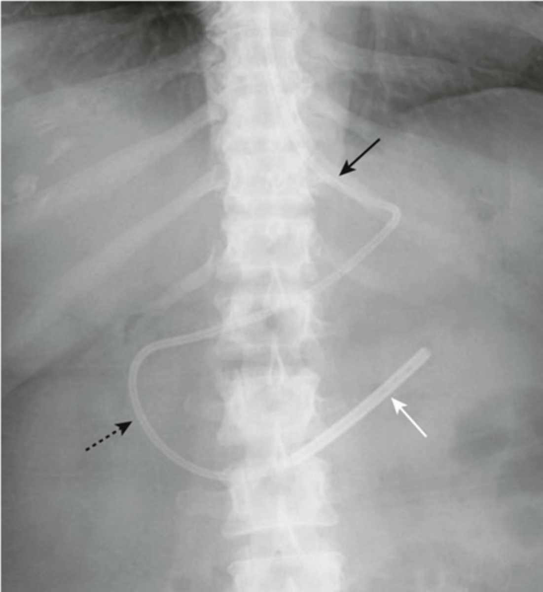 <p>-tip should be in 2nd or 3rd portion of duodenum</p>