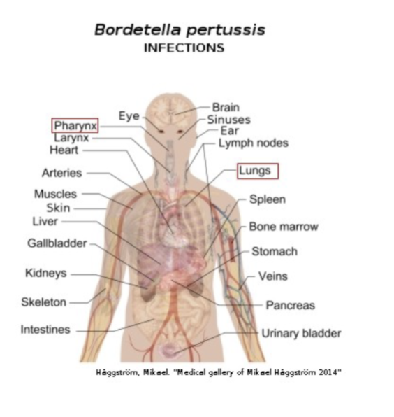 <p>Bordetella Pertussis: Pertussis or whooping cough:</p>