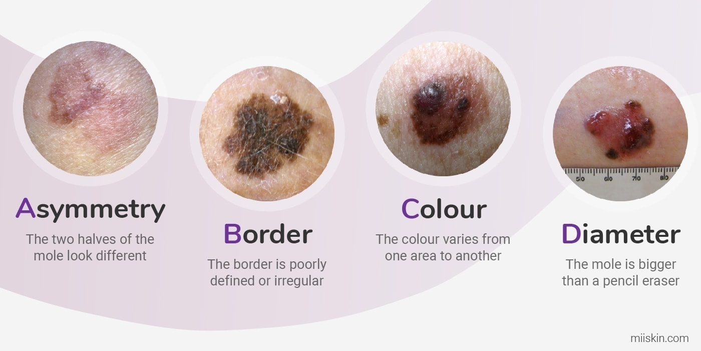 <p>melanoma</p>
