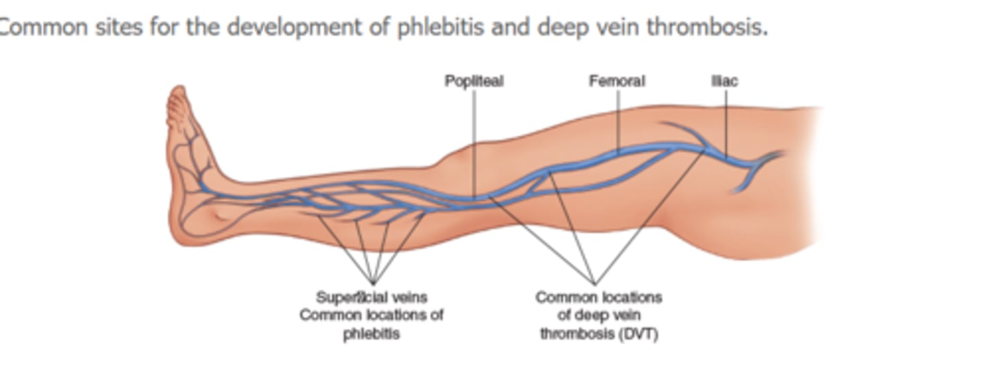 <p>Inflammation of a vein</p>