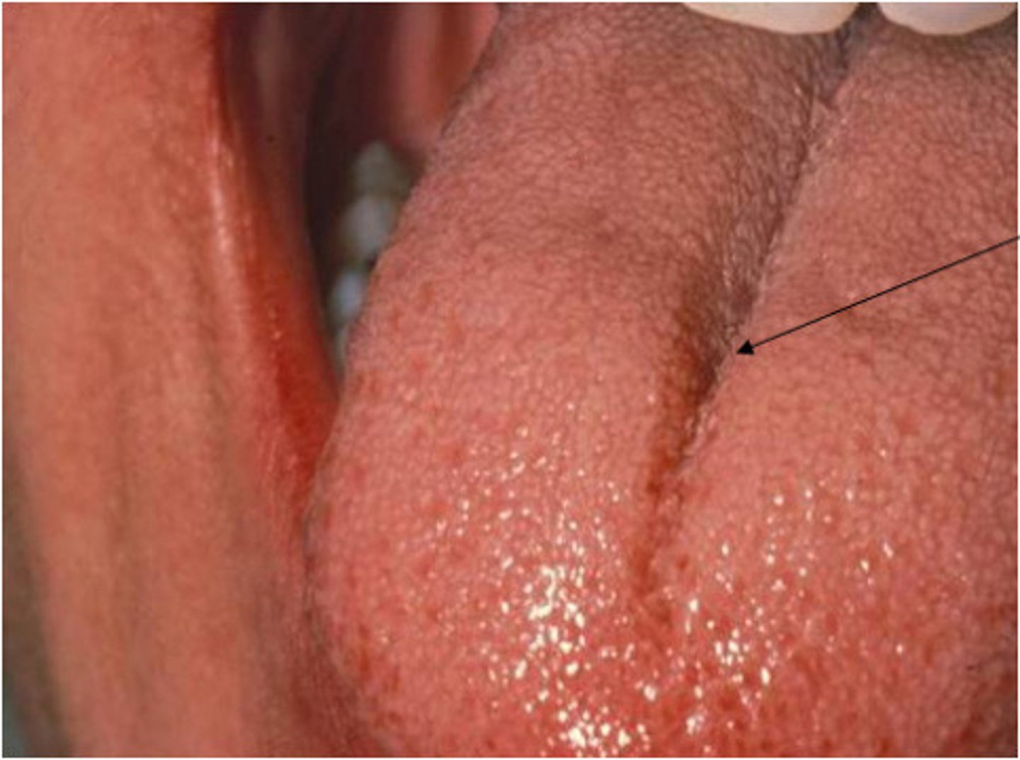 <p>runs anteriorly along the midline of the tongue dorsum</p>