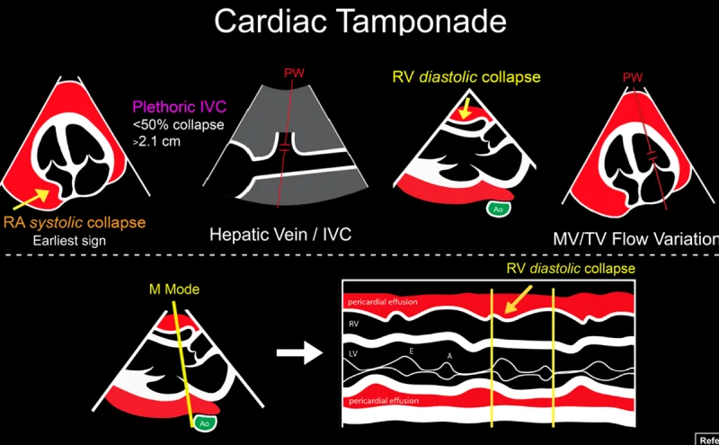 <p>Cardiac tamponade</p>