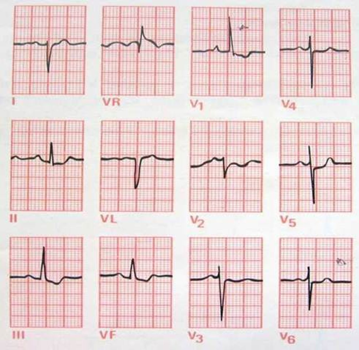 <p>Which Arrythmia is this?</p>