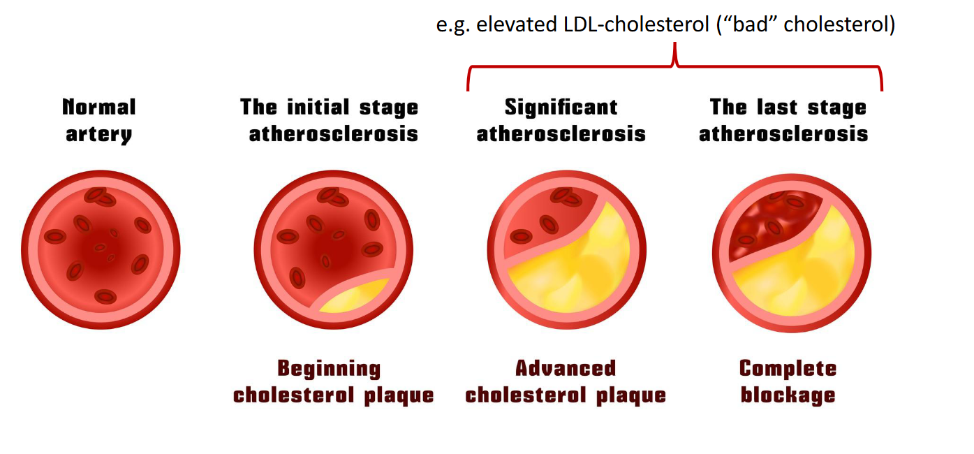 <ul><li><p><span><span>Lipid levels, cholesterol levels are out of whack, so they're outside of that normal, healthy reference range.</span></span></p></li><li><p><span><span>Common type is elevated LDL cholesterol</span></span></p></li><li><p><span><span>LDL is lousy (bad) cholesterol and contributes to plaque buildup in arteries&nbsp;</span></span><span style="background-color: transparent;"><span>narrowing/blocking them</span></span></p></li></ul><p></p>