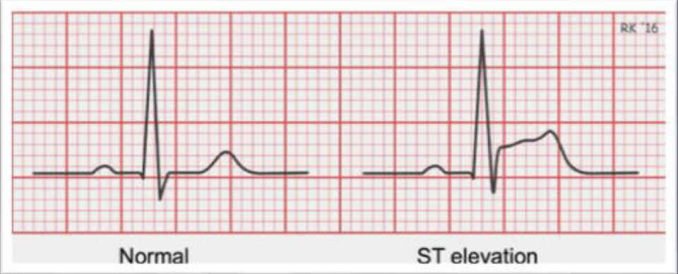 <ol><li><p>myocardial stress</p></li><li><p>may also indicate ventricular damage, from multiple causes such angina, CAD, or evolving myocardial infarction where the heart muscle is not getting enough oxygen</p></li></ol><p></p>