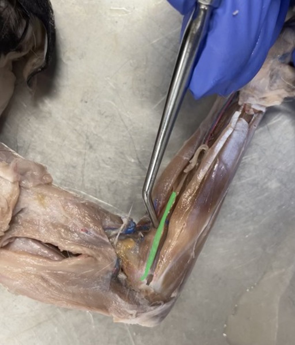 <p>O: ulna</p><p>I: radius</p><p>A: pronates forearm</p>