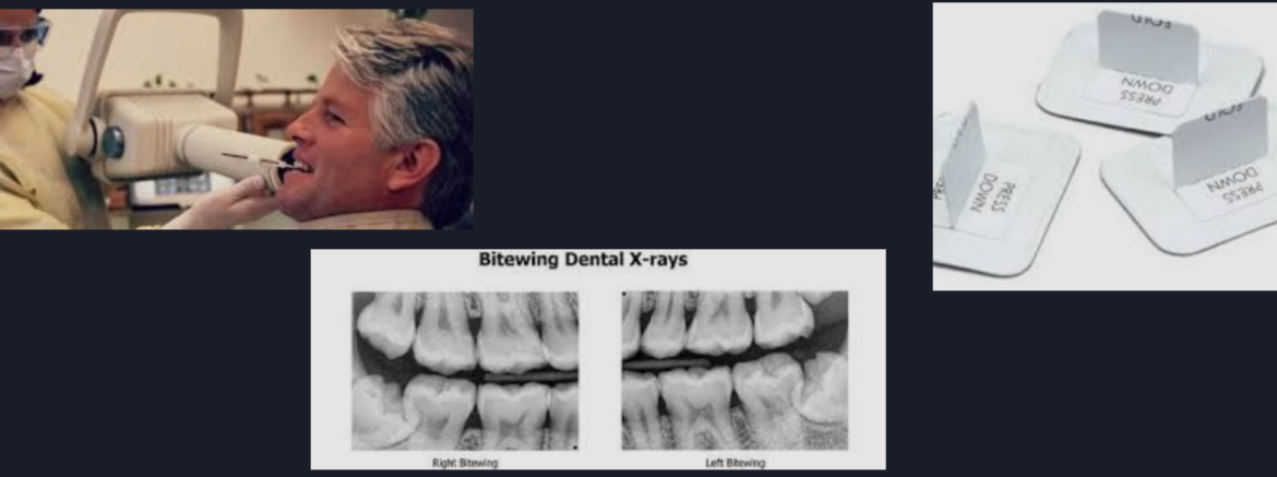 <p>Bitewing X-rays </p>