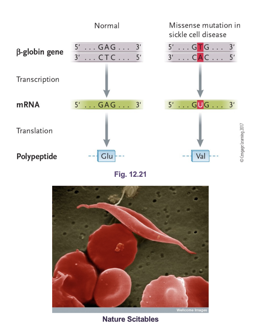 <p>Sickle cell anemia:</p><ul><li><p><span style="color: rgb(255, 255, 255);"><span>A base substitution point mutation in the BETA HEMOGLOBIN gene</span></span></p></li><li><p><span style="color: rgb(255, 255, 255);"><span>The TRANSVERSION results in a MISSENSE mutation that changes the 6th amino acid from glutamic acid (Glu) to valine (Val)</span></span></p></li><li><p><span style="color: rgb(255, 255, 255);"><span>In low oxygen environments, the beta subunit causes hemoglobin molecules to polymerize into LONG FIBERS that alter the shape of RBCs</span></span></p></li><li><p><span style="color: rgb(255, 255, 255);"><span>Leads to deficient gas exchange, clogged arteries (pain), circulatory problems, higher risk of heart attack and stroke</span></span></p></li></ul><p></p>