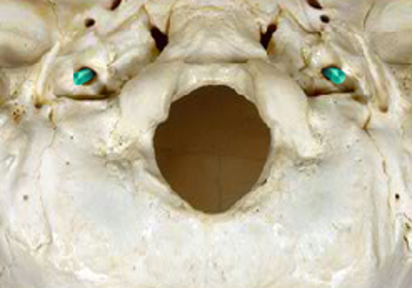 <p>Opens into Foramen Lacerum, transmits internal carotid artery</p>
