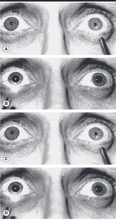 <p><strong>Prescence of unilateral or asymmetric pathology</strong></p><p>Indicates inhibition <u>anterior to the optic chiasm</u></p><p><em>Shining light into one eye constricts both pupils, while shining it into the other&nbsp; does nothing</em></p>