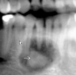 <p>well defined, thin radiolucent rim, RL to RO EXPANSILE lesion, <strong>resorbs roots, loss of lamina dura </strong></p>
