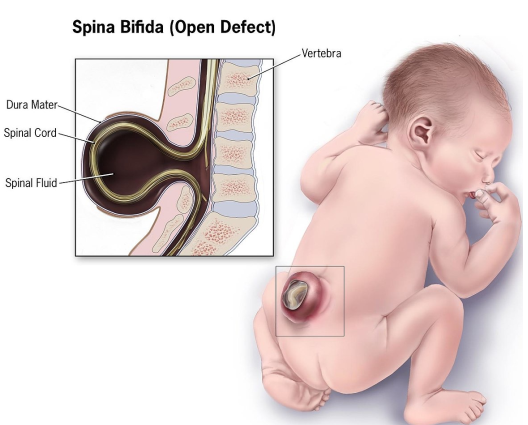 <ul><li><p>Congenital heart disease</p></li><li><p>Spina bifida →&nbsp;A neural tube defect where the vertebral arches fail to fuse over the spinal cord during embryonic development.</p></li></ul><p></p>