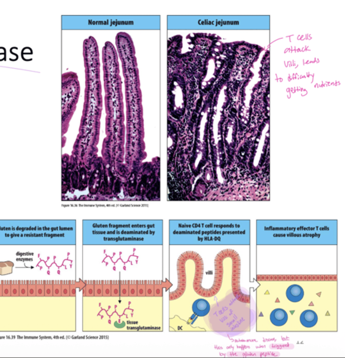 <p>A: Atrophy (flattening) of the intestinal villi.</p><p>this leads to malnourishment, failure to thrive, anemia, depression and predisposition to intestinal cancer</p>