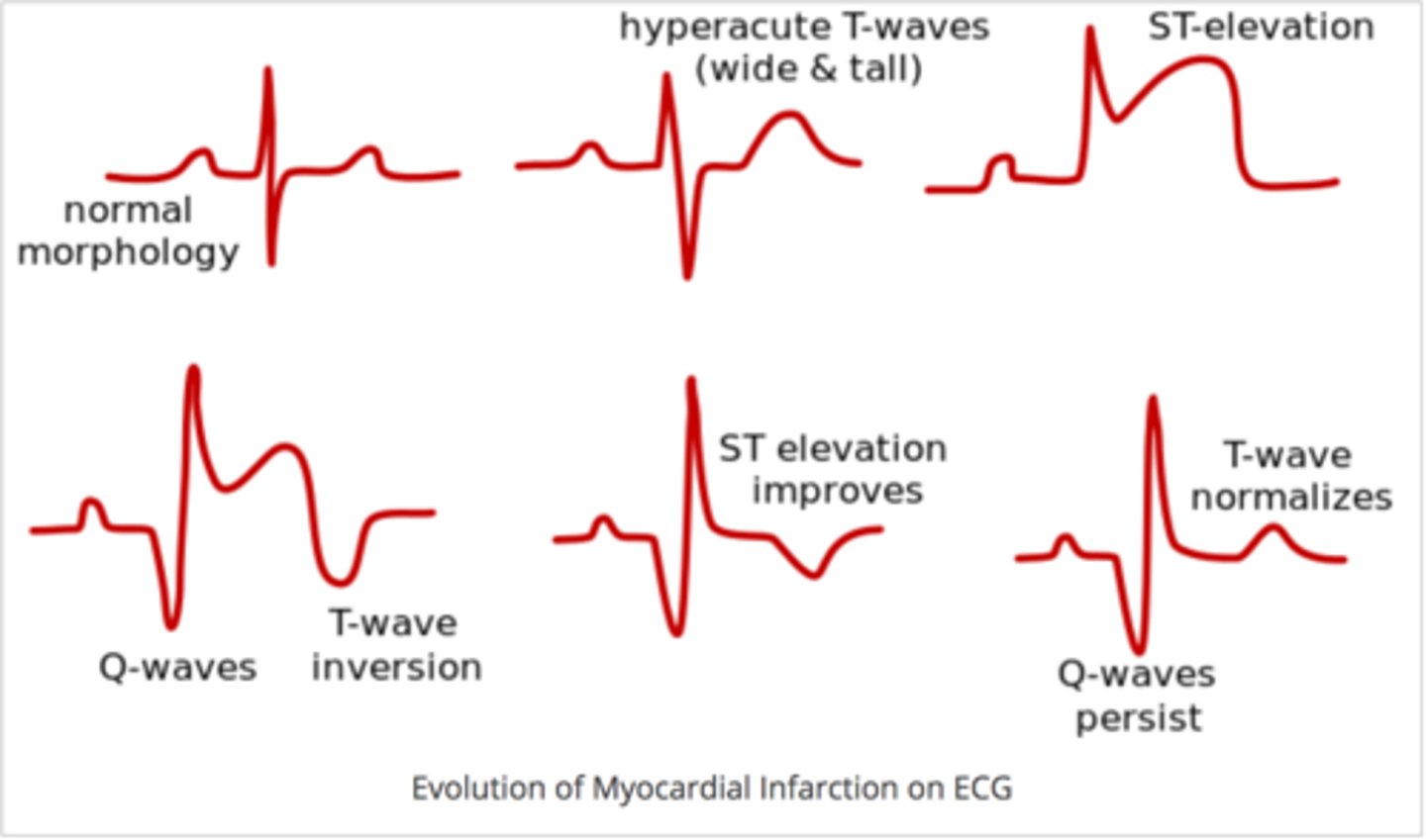<p>- hyperacute T waves</p><p>- T wave straightening</p><p>- ST elevation</p><p>- Q-wave development</p><p>- T wave inversion</p>