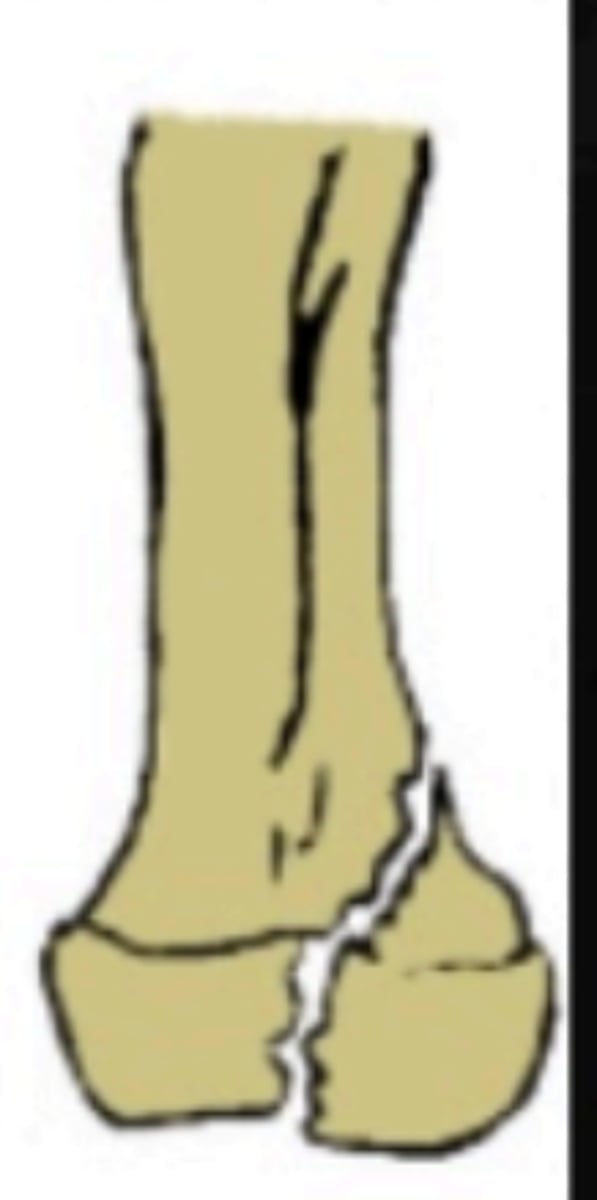 <p>Which Salter-Harris fracture is pictured?</p>