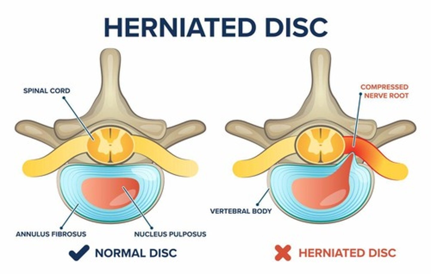 <p>A condition in which a disc in the spine bulges out.</p>