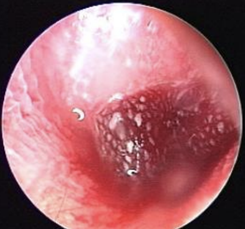 <p>identify the appropriate finding with the following tympanic membrane:</p>