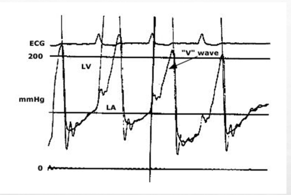<p>increased V wave in PCW signifies what valvular assessment</p>