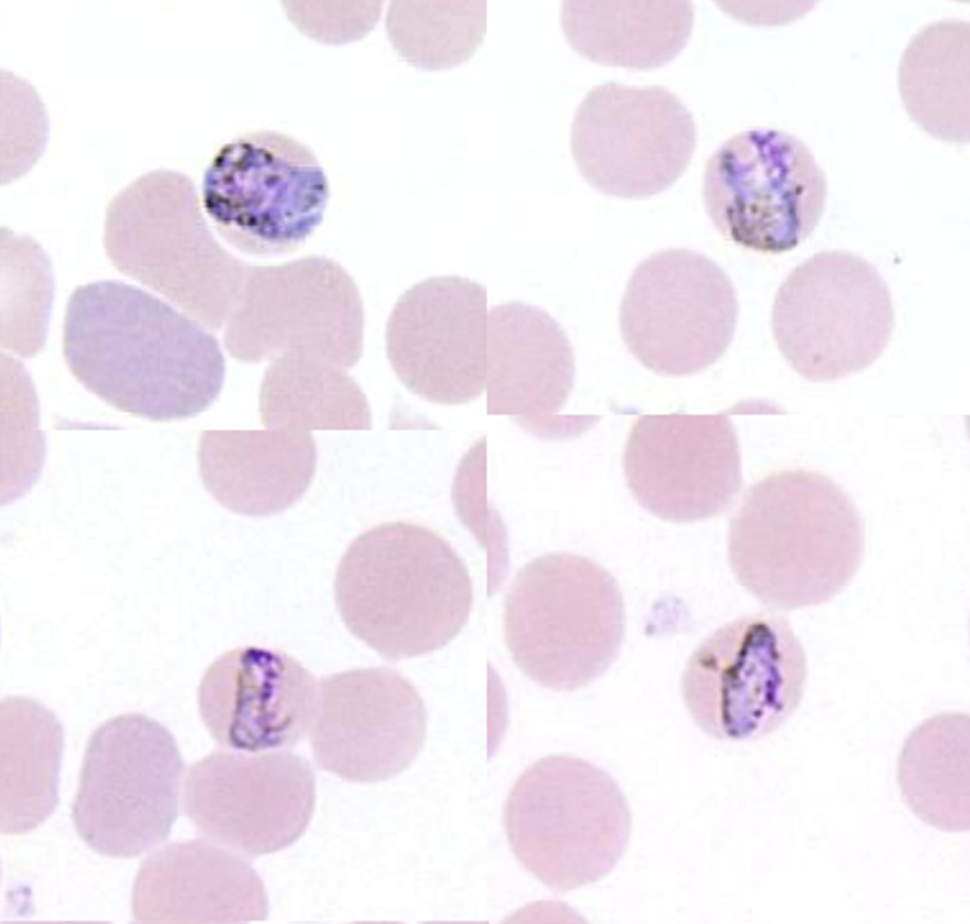 <p>Name: Plasmodium malariae</p><p class="p1">Stage: trophozoite</p><p class="p1">*<span> </span>trophozoite is stretched across the RBC like a horizontal bar.</p>