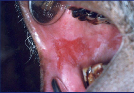 <p>Thinning of the epithelium, associated with areas of erosion/ulceration</p>