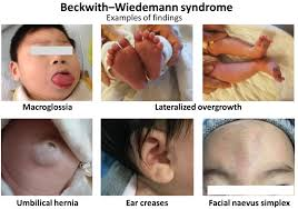 <p>What is an example of uniparental disomy? </p><p>-caused by inheriting two copies of chromosome 11 from the father</p><p>-phenotype: overgrowth, heightened risk of cancerous tumors, large tongue at birth, creases on earlobes, omphalocele</p>