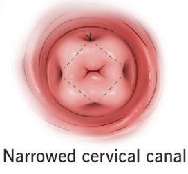 <p>Incompetent cervix management - HARD PASS BRO</p>