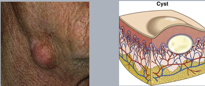 <p>cyst</p>