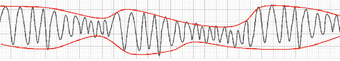 <p>__ is a particular pleomorphic form of V-tach associated with a prolonged QT interval and QRS complexes of changing amplitude and a twisted helix shape. </p>