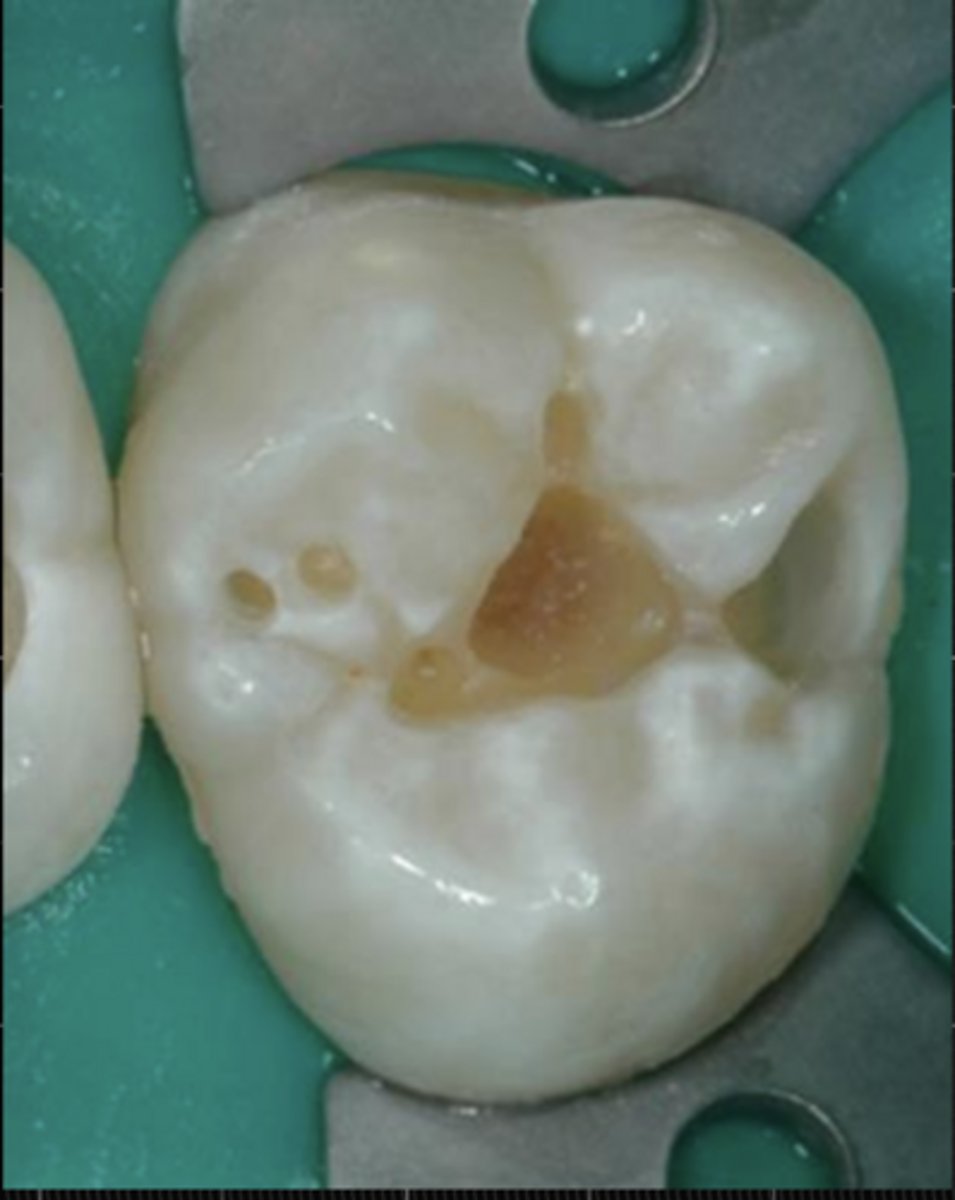 <p>Physically resistant to hand excavation, and some pressure needs to be exerted through an instrument to lift it</p>