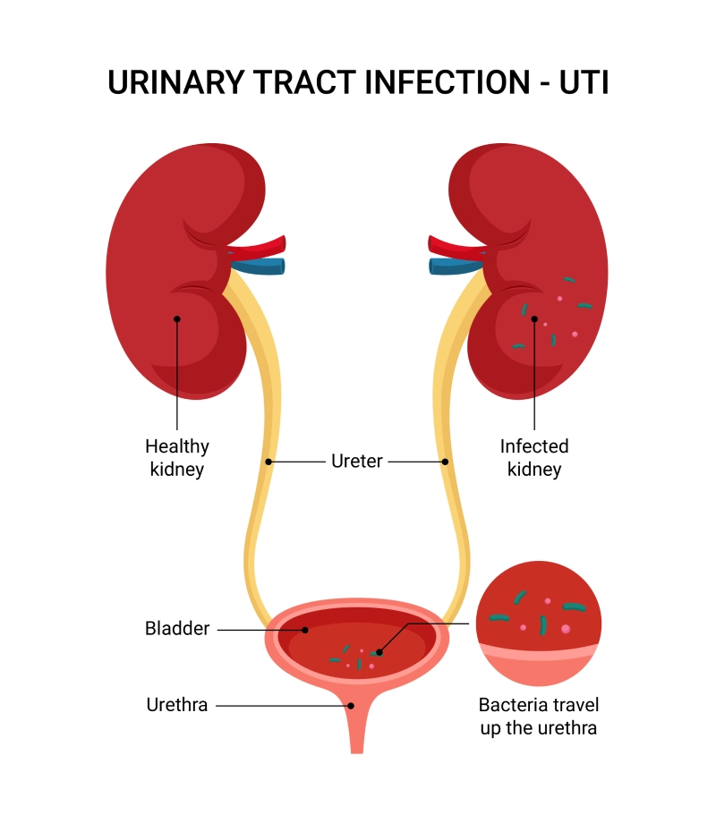 <ol><li><p>Catheter in place - colonization COMMON</p><ol><li><p>+ urine culture for yeast </p></li><li><p>Remove foley if possible</p></li></ol></li><li><p>UTI = uncommon </p><ol><li><p>Sx of UTI in absence of bacteria or foley catheter</p></li><li><p>Obstruction → increases risk of invasive infection</p></li></ol></li><li><p>Treatment is uncommon </p></li></ol><p></p>