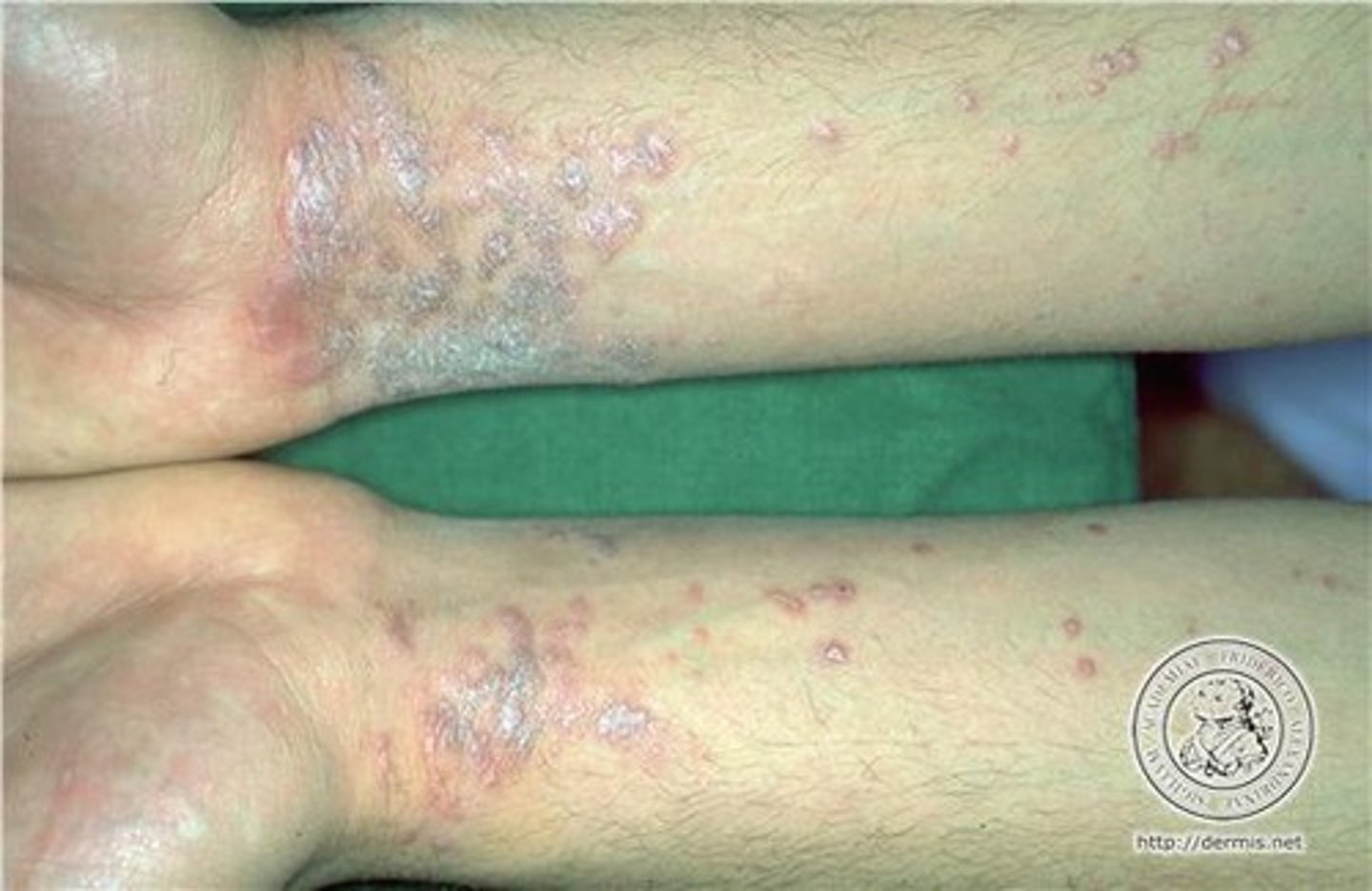 <p>1. Pruritus**</p><p>2. Purple (violaceous)</p><p>3. Polygonal</p><p>4. Planar</p><p>5. Papule or Plaques</p>