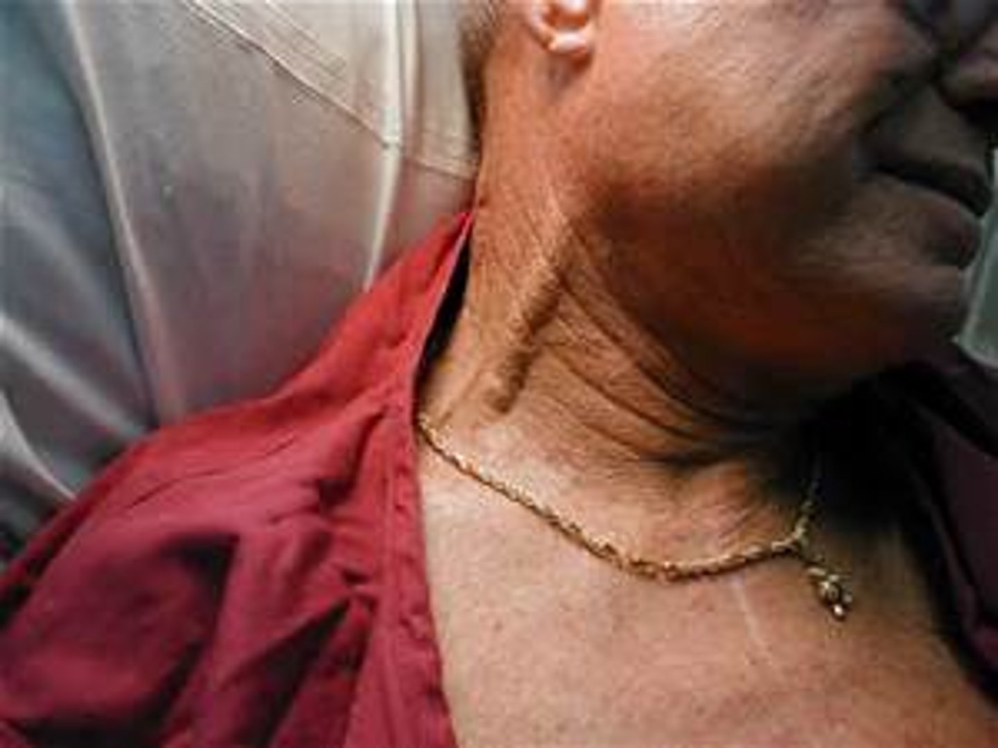 <p>bulging of blood veins on the sides of the neck</p>