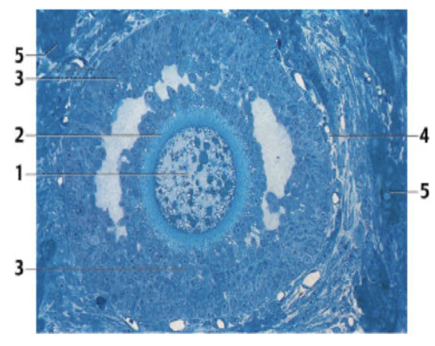 <p>A 42-year-old woman presents with vague lower abdominal pain. She has regular menstrual periods with a 28-day cycle. Laboratory exams are significant for an elevated serum CA 125. Transvaginal ultrasonography reveals a right adnexal mass. She is diagnosed with cancer and subsequently treated with surgical resection of the organ from which the figure has been obtained.</p><p>Which organ in this case has cancer?</p>