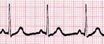 <p>Which cardiac rhythm is shown?</p>