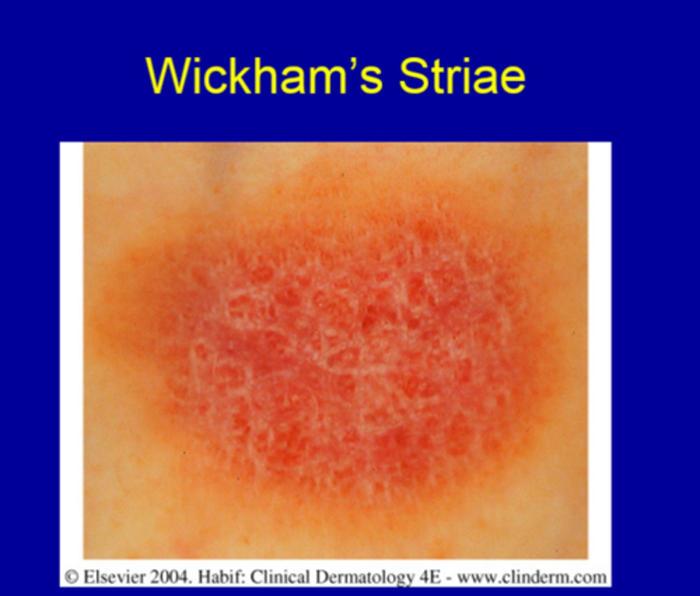 <p>Wickham striae</p>