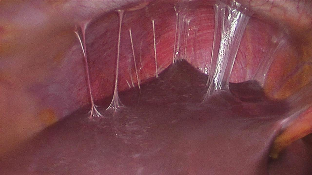 what type of scar formation is this?
