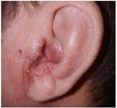 <p>Acute diffuse otitis externa</p><p>Most commonly due to bacterial or fungal infections after minor trauma to the ear</p>